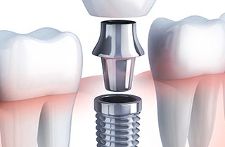 depiction of a dental implant