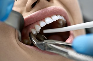 Closeup of forceps grasping woman’s tooth