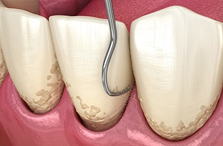 a 3D illustration of scaling and root planing being performed 