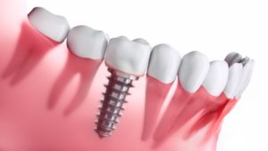 a dental implant