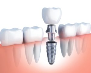 Dental implant post, crown, abutment