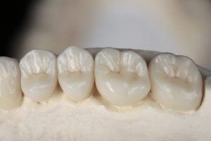 Dental crowns