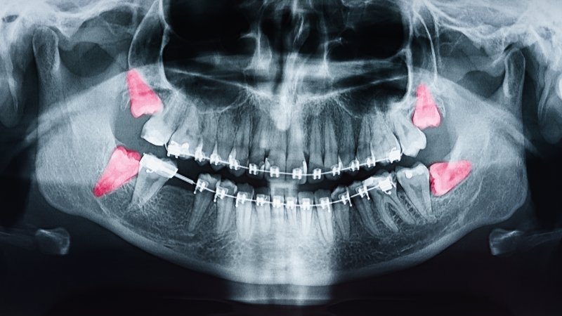 X-ray of wisdom teeth in Mesquite