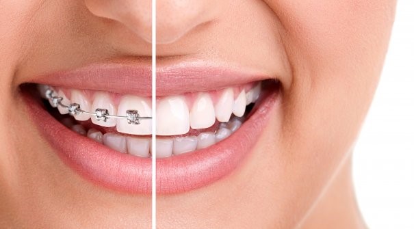 The split image of a woman both with and without braces