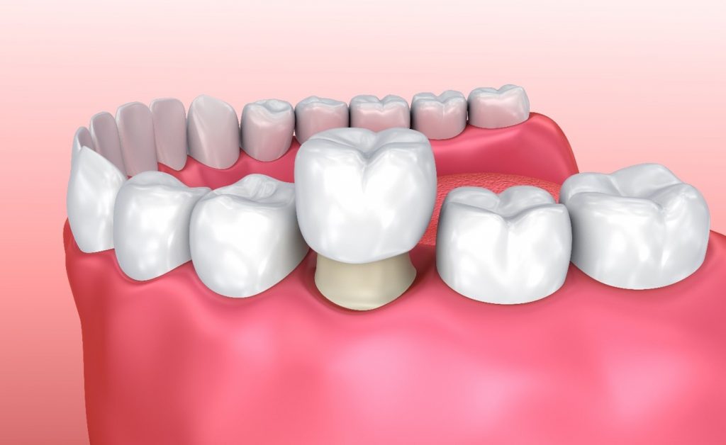 illustration of dental crown placement