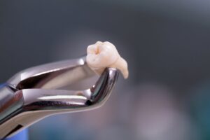 Dentist holding wisdom tooth with dental forceps