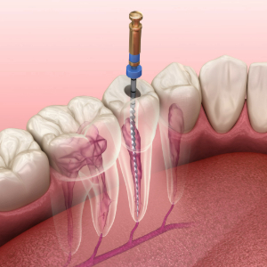 Illustration of root canal treatment for tooth in lower arch